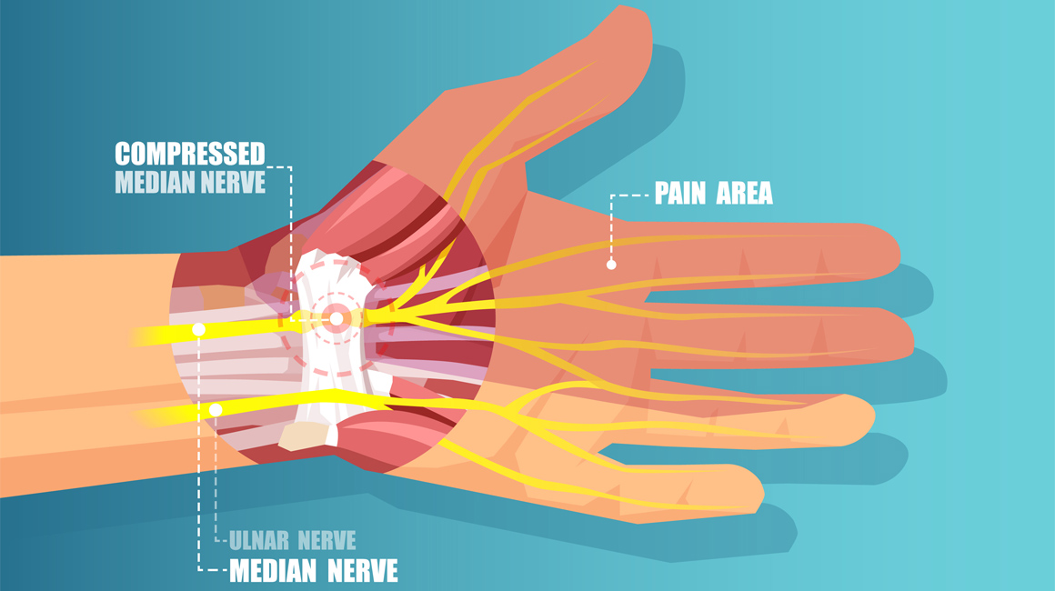 Carpal tunnel syndrome что это