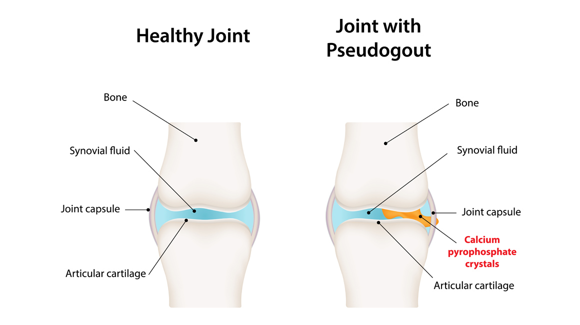 Pseudogout