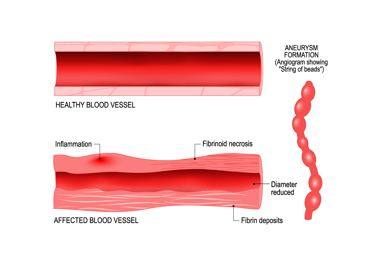 Vasculitis